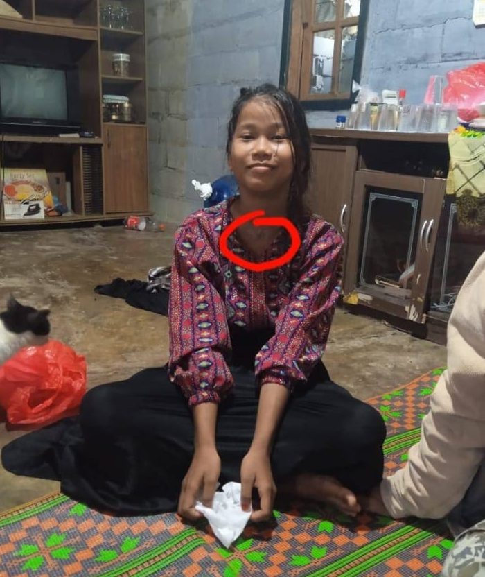 Tertembak Senapan Angin di Bagian Lehernya, Bocah SMP Ini Kesulitan Biaya Operasi