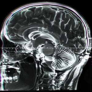 Seni Kesalahan Gangguan Otak