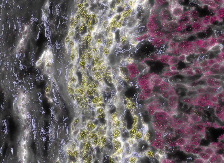 Tumor FLC