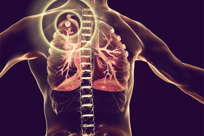 Pengobatan dan pencegahan tuberkulosis