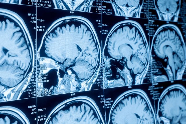 Layar Pemindaian Otak MRI