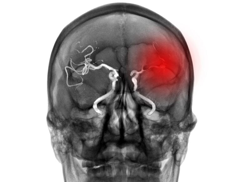 CT scan otak stroke berdarah