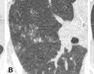 Dada Non-Contrast CT Lung Window Images pada peserta pria berusia 70 tahun