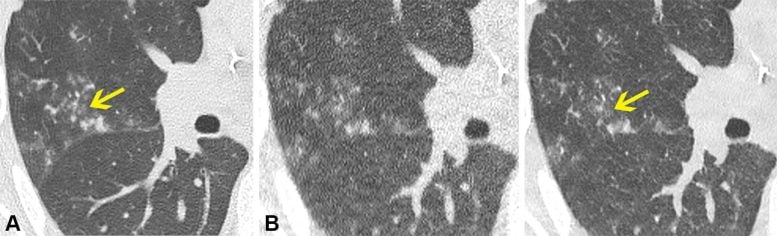 Dada Non-Contrast CT Lung Window Images pada peserta pria berusia 70 tahun