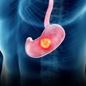 Ilustrasi konsep tumor lambung lambung lambung