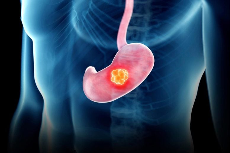 Ilustrasi konsep tumor lambung lambung lambung