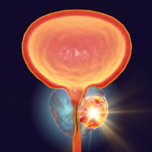 Ilustrasi pengobatan kanker prostat