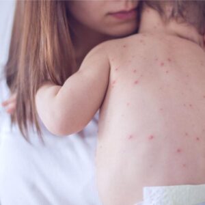 Baby campak cacar air