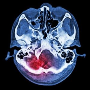 Pakar Nutrisi mengungkapkan pertukaran makanan #1 untuk mengurangi risiko stroke Stroke cedera otak