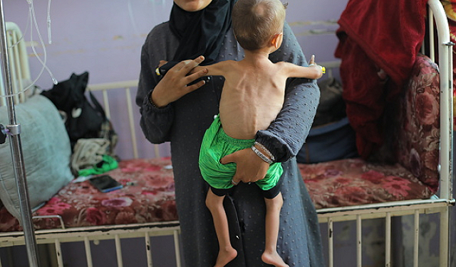 UNICEF: 112 Anak Gazan yang didiagnosis dengan kekurangan gizi akut setiap hari