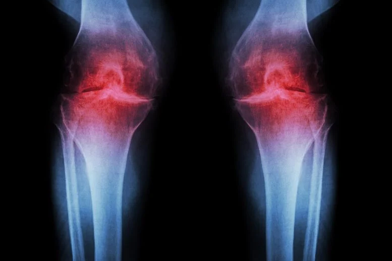 Osteoartritis Lutut