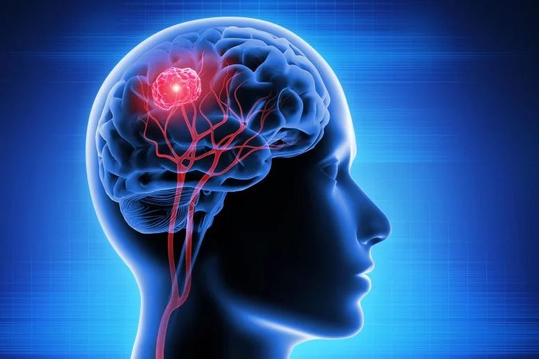 Pembuluh Darah Tumor Kanker Otak Kepala Manusia 3D