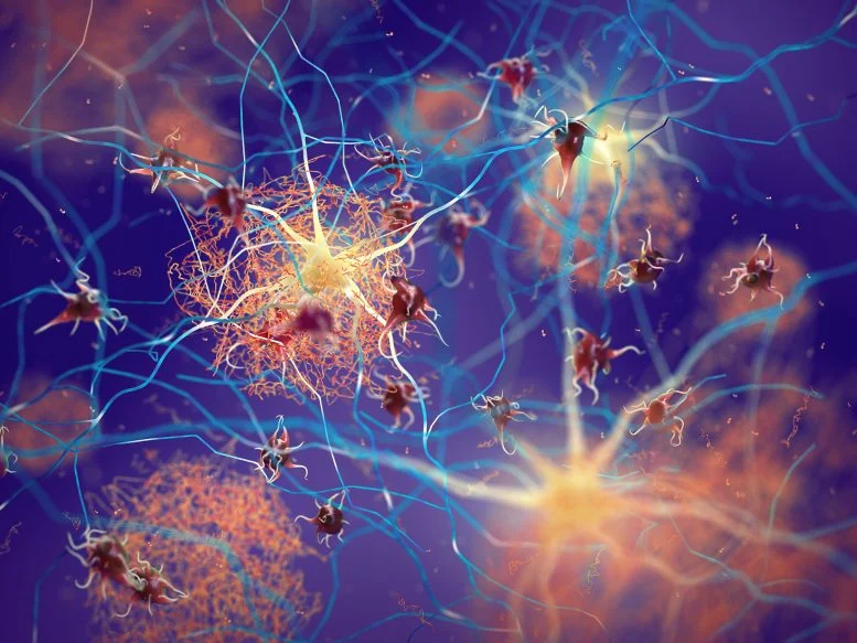 Plak Amiloid Neuron Demensia Alzheimer